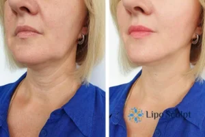 Double chin before and after Hi-Fu treatment 4 Book your double chin treatment Clacton-on-Sea today! We are here to help!