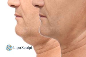 Double chin before and after Hi-Fu treatment 2 Double chin treatment Clacton-on-Sea from Lipo Sculpt - feel more confident today!