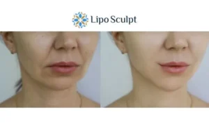 Explaining Total Skin Tightening Treatment And What It Can Do For You 2 Do you want to boost your self confidence? Give Morpheus8 Clacton-on-Sea a try today!