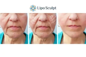Explaining Total Skin Tightening Treatment And What It Can Do For You 3 Boost your confidence with Morpheus8 Clacton-on-Sea call our team today!