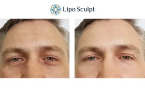 Explaining Total Skin Tightening Treatment And What It Can Do For You 6 Morpheus8 Clacton-on-Sea book in today to find out more!