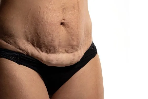 Lost the Weight but Not the Loose Skin? 1 image of womans stomach after weight loss showing loose skin Clacton-on-Sea